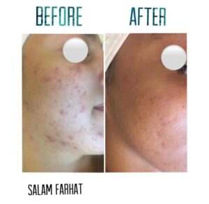 Read more about the article Facial Treatment