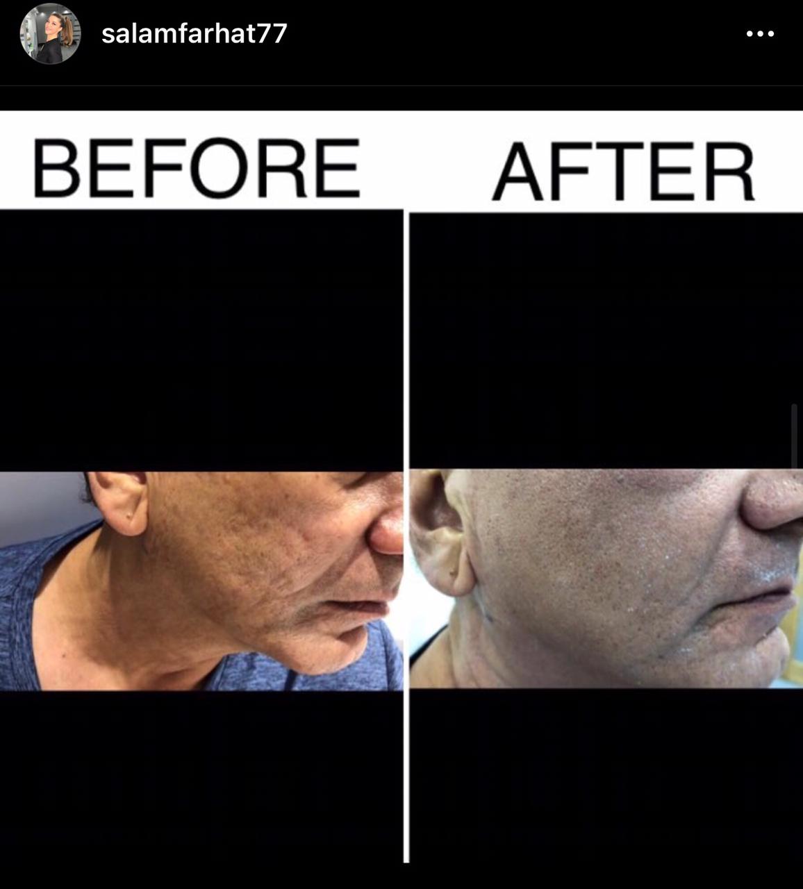 You are currently viewing Acne Scar and Dilated Pores Treatment