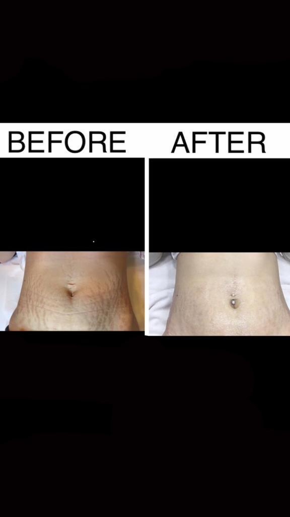 You are currently viewing STRETCH MARKS REMOVAL