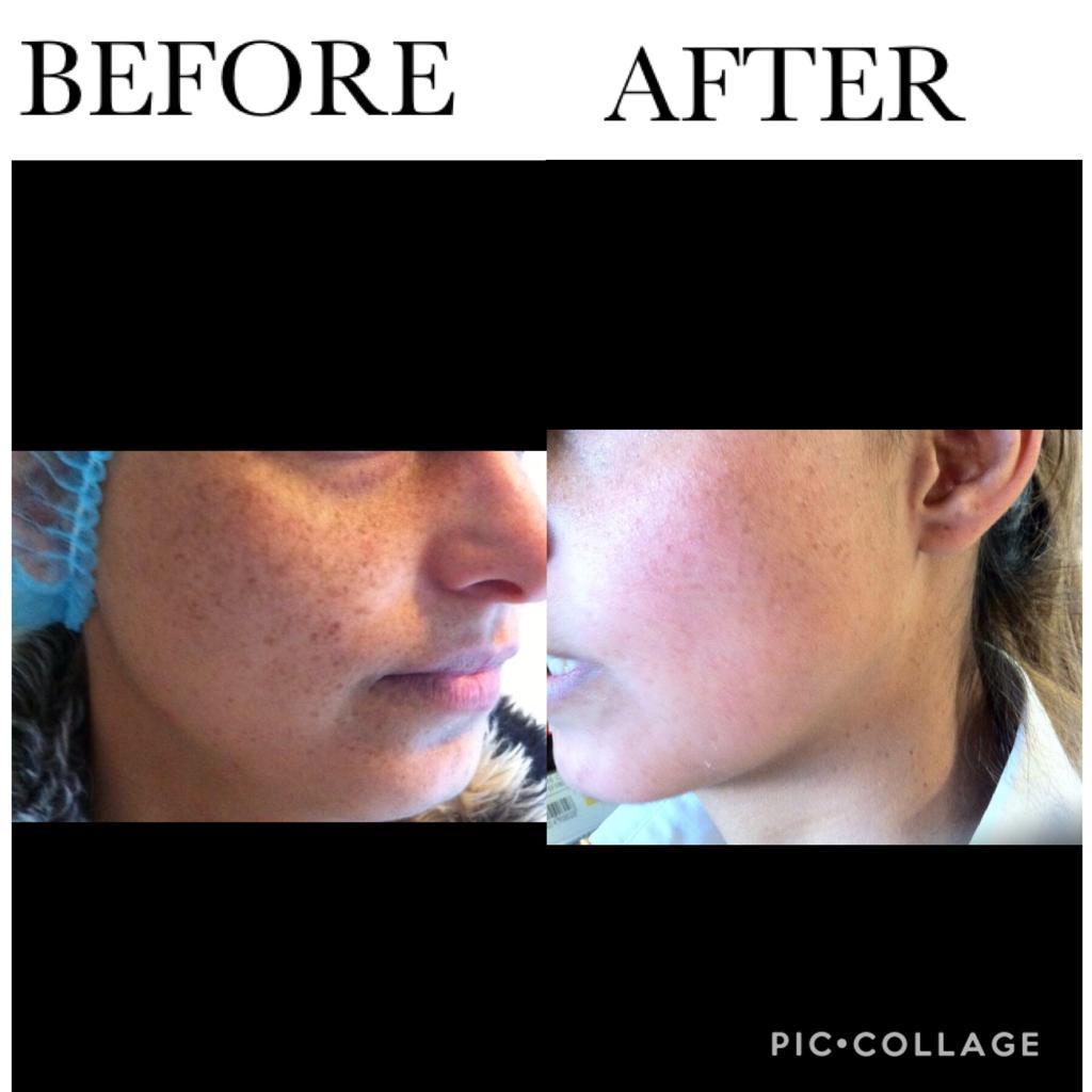 You are currently viewing Melasma and Freckles Treatment