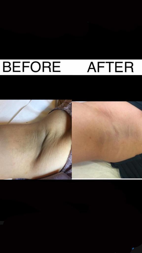 You are currently viewing Pigmentation treatment